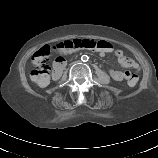 Active bleeding from duodenal ulcer with embolization (Radiopaedia 34216-35481 Axial non-contrast 34).png
