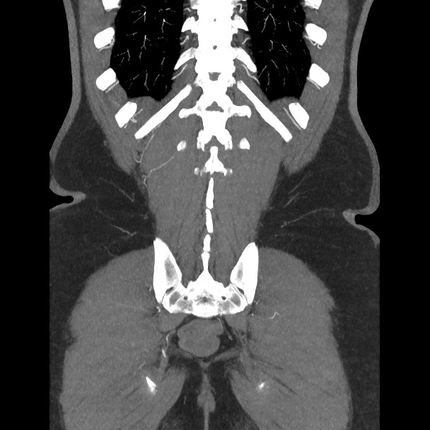Active colonic bleed on CT (Radiopaedia 49765-55025 Coronal art MIP 52).jpg