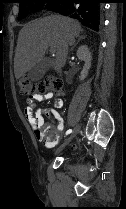 Active lower gastrointestinal bleeding - diverticular (Radiopaedia 61203-69106 Sagittal C+ arterial phase 105).jpg