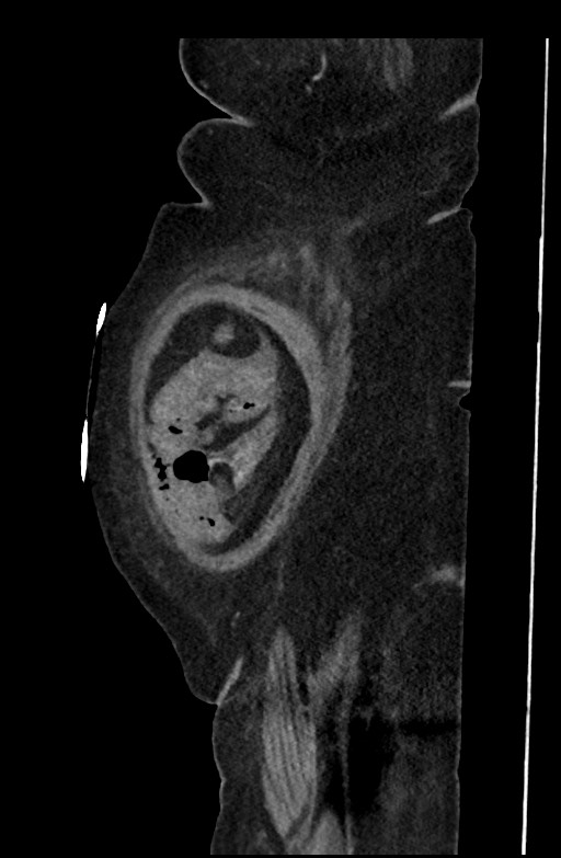 Active renal extravasation with large subcapsular and retroperitoneal hemorrhage (Radiopaedia 60975-68796 Sagittal C+ portal venous phase 196).jpg