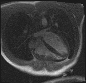File:Active right ventricular cardiac sarcoidosis (Radiopaedia 55596-62100 Axial Dynamic perfusion scan MOCO 46).jpg