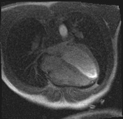 Active right ventricular cardiac sarcoidosis (Radiopaedia 55596-62100 Axial Dynamic perfusion scan MOCO 78).jpg