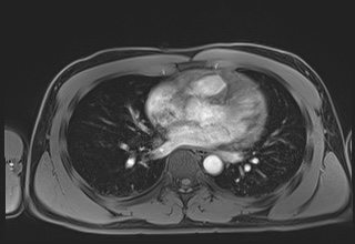 File:Active right ventricular cardiac sarcoidosis (Radiopaedia 55596-62100 Axial Post contrast Dixon 41).jpg
