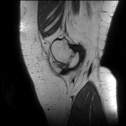 Acute-on-chronic transient lateral patellar dislocation with trochlear dysplasia (Radiopaedia 84099-99349 Sagittal PD 29).jpg