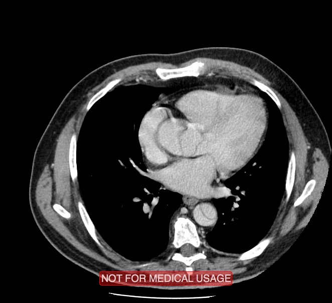 Acute aortic dissection - Stanford type A (Radiopaedia 40661-43285 Axial C+ portal venous phase 33).jpg