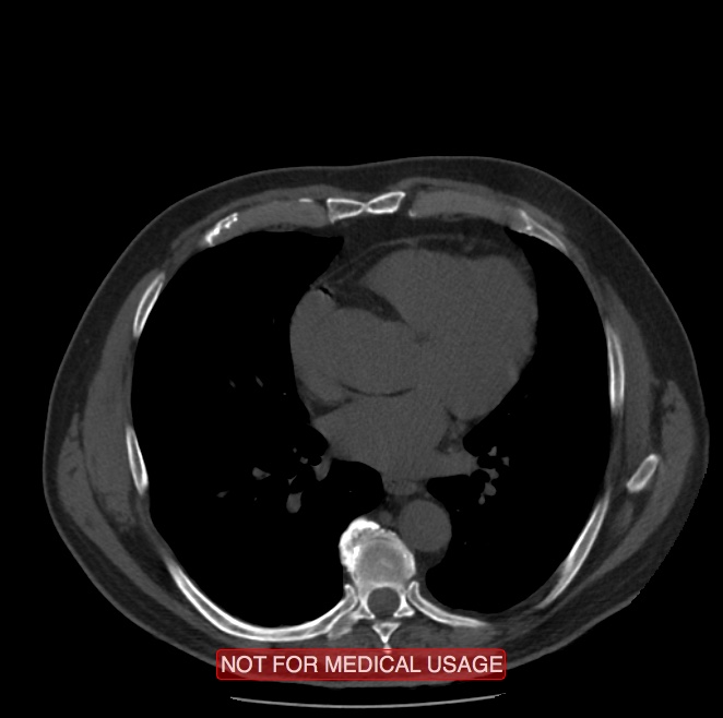 Acute aortic dissection - Stanford type A (Radiopaedia 40661-43285 Axial non-contrast 36).jpg