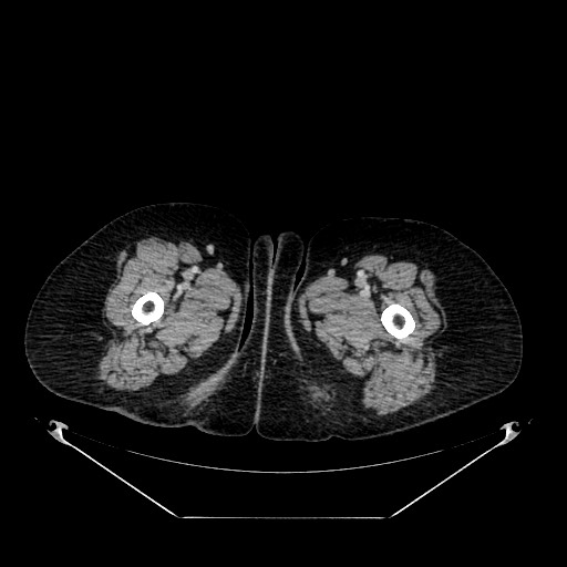 File:Acute appendicitis, heterotaxy syndrome (Radiopaedia 66884-76202 Axial 150).jpg