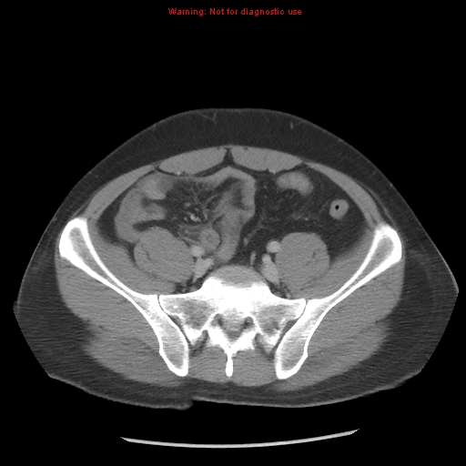 Acute appendicitis (Radiopaedia 10498-10973 Axial C+ portal venous phase 29).jpg