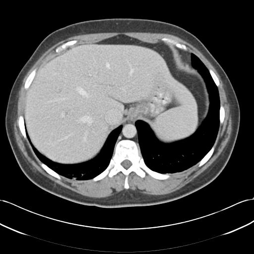 File:Acute appendicitis (Radiopaedia 30297-30934 Axial C+ portal venous phase 13).jpg