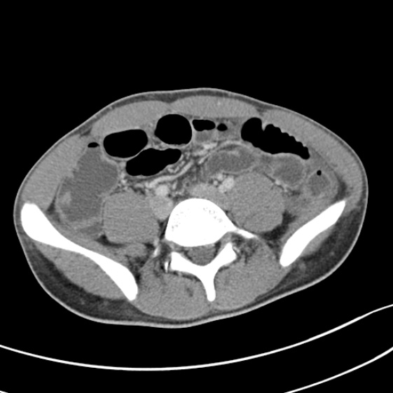 Acute appendicitis (Radiopaedia 32614-33572 Axial C+ portal venous phase 44).jpg
