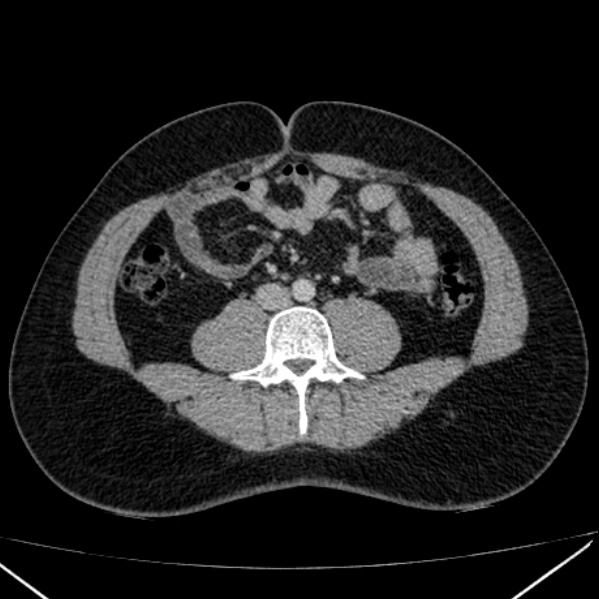 Acute appendicitis (Radiopaedia 38255-40270 Axial C+ portal venous phase 61).jpg