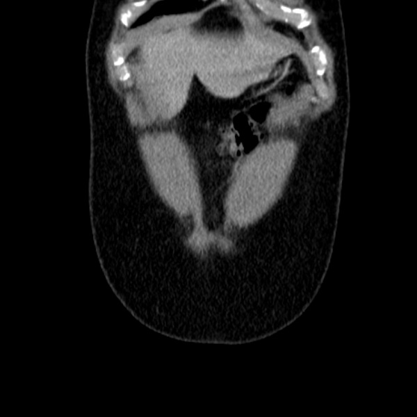 File:Acute appendicitis (Radiopaedia 38255-40270 Coronal C+ portal venous phase 14).jpg