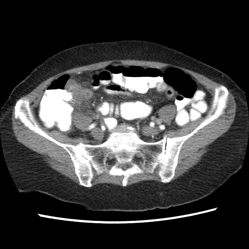 File:Acute appendicitis (Radiopaedia 52672-58589 Axial C+ arterial phase 16).jpg
