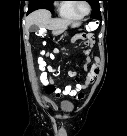 Acute appendicitis (Radiopaedia 77016-88960 Coronal C+ portal venous phase 34).jpg