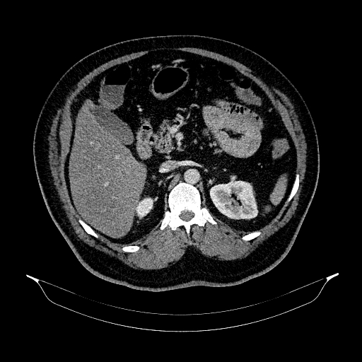 Acute appendicitis (Radiopaedia 79950-93224 Axial C+ portal venous phase 37).jpg