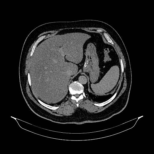 Acute appendicitis (Radiopaedia 79950-93224 Axial non-contrast 20).jpg