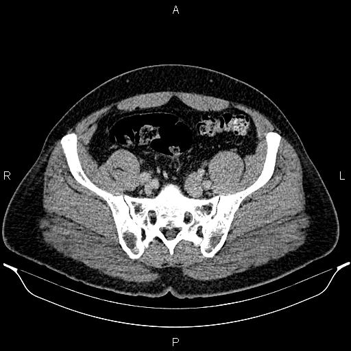 Acute appendicitis (Radiopaedia 84780-100240 Axial C+ portal venous phase 84).jpg