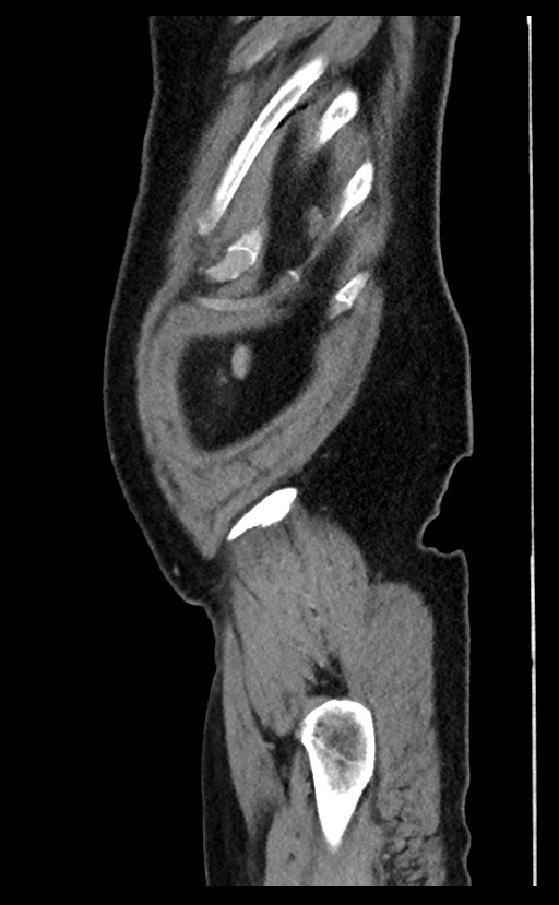 Acute appendicitis - large appendicoliths (Radiopaedia 61805-69820 Sagittal C+ portal venous phase 8).jpg