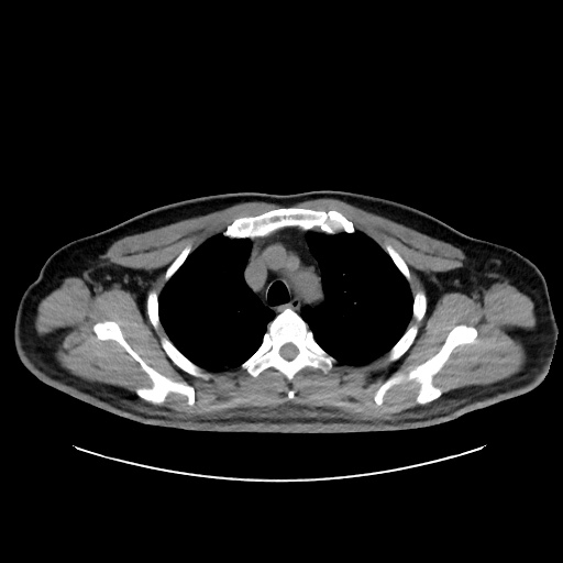Acute appendicitis and COVID 19 pneumonia (Radiopaedia 76604-88380 Axial non-contrast 15).jpg