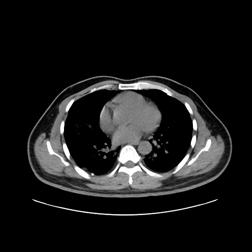 Acute appendicitis and COVID 19 pneumonia (Radiopaedia 76604-88380 Axial non-contrast 31).jpg