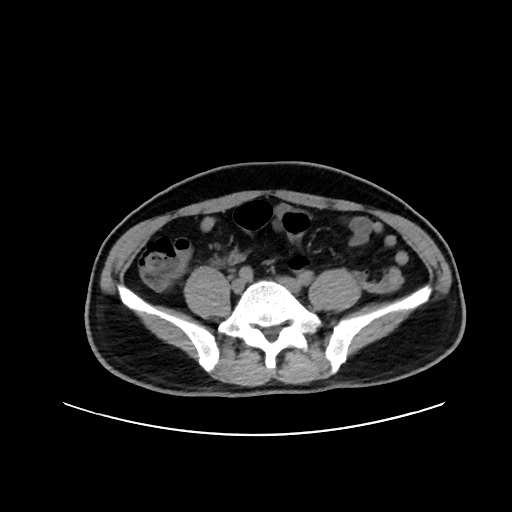Acute appendicitis and COVID 19 pneumonia (Radiopaedia 76604-88380 Axial non-contrast 93).jpg