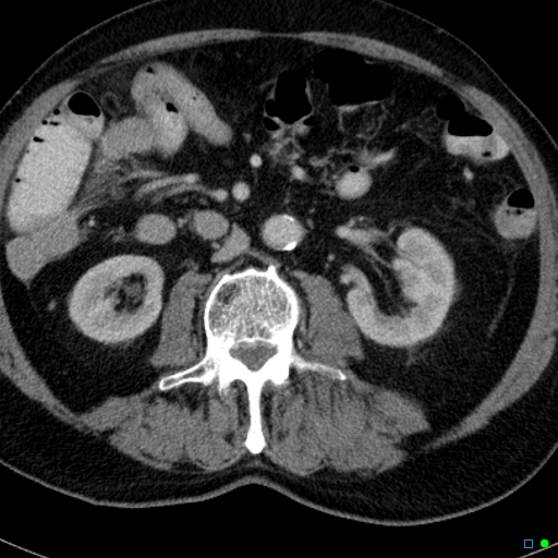 File:Acute appendicitis arising from a malrotated cecum (Radiopaedia 19970-19997 Axial C+ portal venous phase 13).jpg