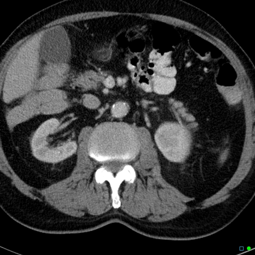 File:Acute appendicitis arising from a malrotated cecum (Radiopaedia 19970-19997 Axial C+ portal venous phase 9).jpg