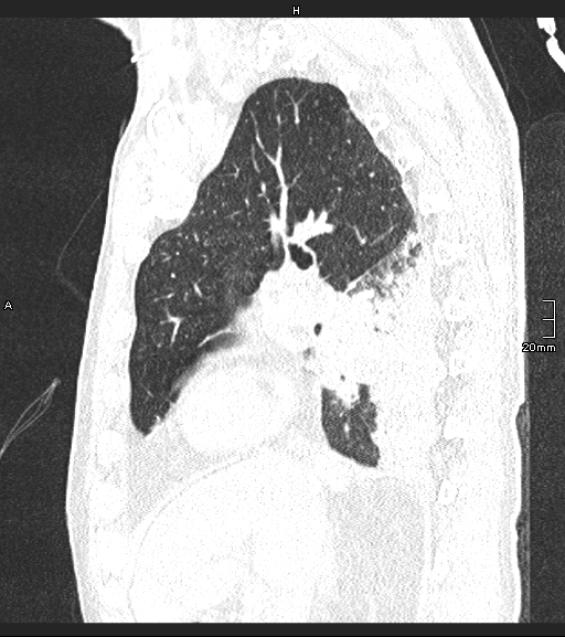 File:Acute aspiration pneumonitis (Radiopaedia 55642-62166 Sagittal lung window 97).jpg
