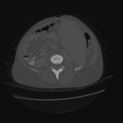 File:Acute calculous cholecystitis in patient with osteopetrosis (Radiopaedia 77871-90159 Axial bone window 31).jpg