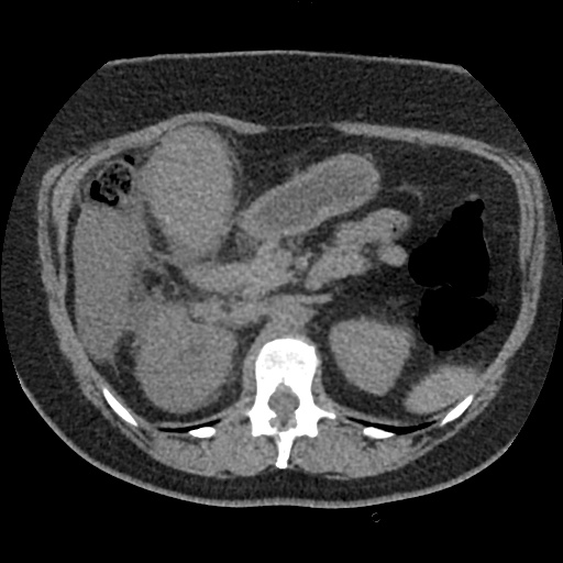 File:Acute cholecystitis and ureteric colic (Radiopaedia 42330-45444 Axial prone 31).jpg
