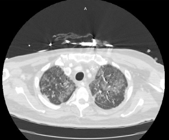 Acute cor pulmonale (ultrasound) (Radiopaedia 83508-98818 Axial lung window 18).jpg