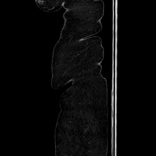 Acute diverticulitis - transverse colon (Radiopaedia 87063-103327 Sagittal C+ portal venous phase 28).jpg