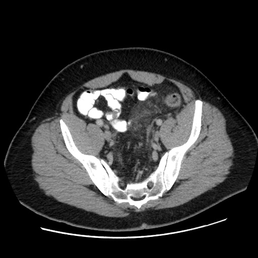 Acute diverticulitis with localized perforation (Radiopaedia 41296-44113 Axial C+ portal venous phase 73).jpg