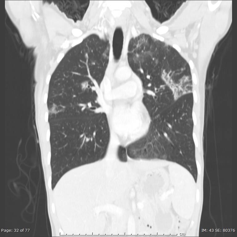 Acute eosinophilic pneumonia (Radiopaedia 48211-53073 Coronal lung window 21).jpg