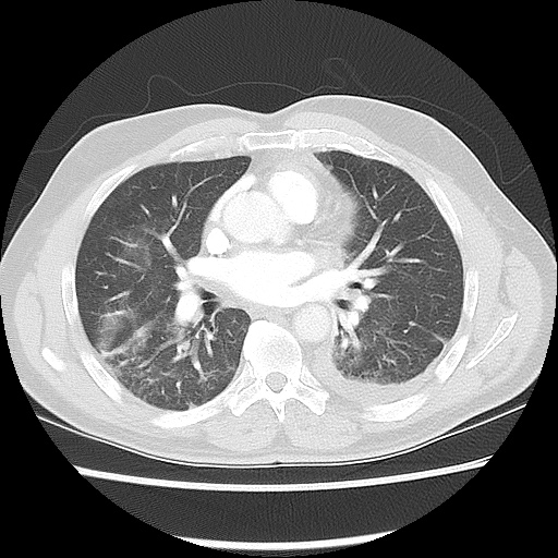 Acute epicardial fat necrosis (Radiopaedia 42327-45440 Axial lung window 32).jpg