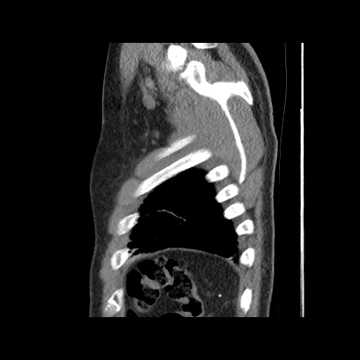 Acute epicardial fat necrosis (Radiopaedia 42327-45440 Sagittal C+ CTPA 63).jpg