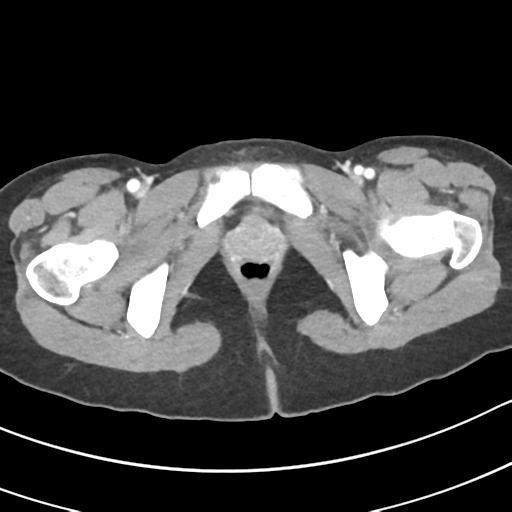 Acute gangrenous appendicitis with perforation (Radiopaedia 40152-42662 Axial C+ portal venous phase 77).png
