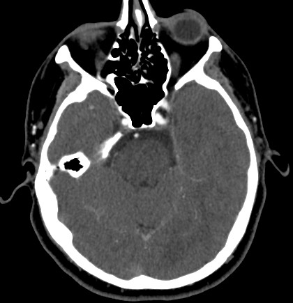 Acute internal carotid artery dissection (Radiopaedia 53541-59630 Axial C+ arterial phase 21).jpg