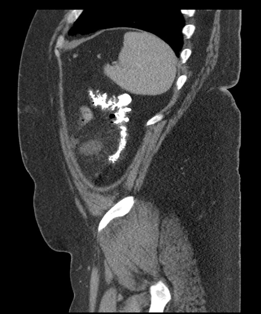 Acute mesenteric venous ischemia (Radiopaedia 46041-50383 Sagittal C+ portal venous phase 101).jpg
