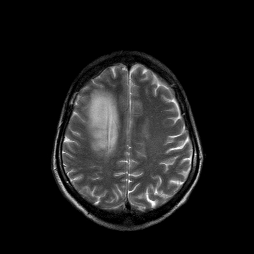 File:Acute necrotizing toxoplasma encephalitis (Radiopaedia 10683-11149 Axial T2 5).jpg