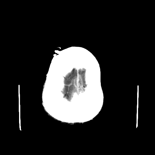 File:Acute necrotizing toxoplasma encephalitis (Radiopaedia 10683-11150 C+ arterial phase 4).jpg