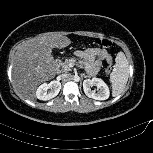 Acute on chronic pancreatitis (Radiopaedia 80902-94423 Axial C+ portal venous phase 57).jpg