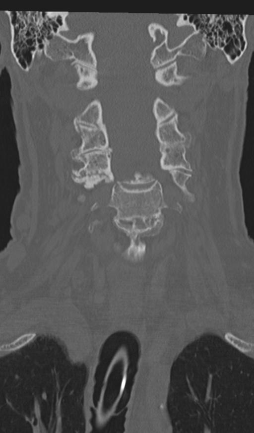 Acute on chronic subdural hematoma and thoracic vertebral injury in a multitrauma patient (Radiopaedia 31698-32619 Coronal bone window 23).jpg