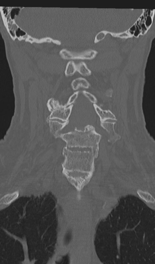 Acute on chronic subdural hematoma and thoracic vertebral injury in a multitrauma patient (Radiopaedia 31698-32619 Coronal bone window 31).jpg