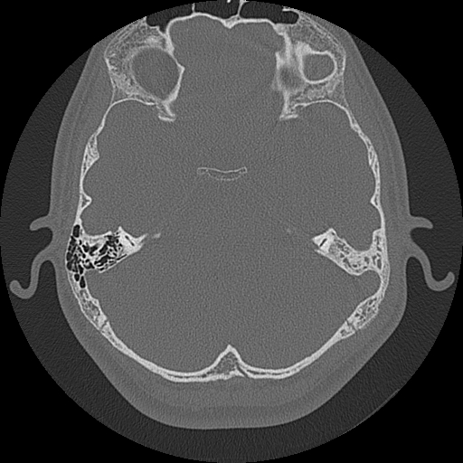 Acute otomastoiditis and Bezold abscess (Radiopaedia 88184-104786 Axial bone window 45).jpg