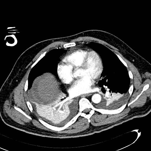 File:Acute pancreatic necrosis (Radiopaedia 13560-13486 Axial C+ portal venous phase 6).jpg