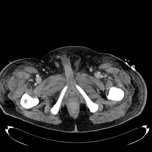 Acute pancreatic necrosis (Radiopaedia 13560-18503 Axial C+ portal venous phase 90).jpg