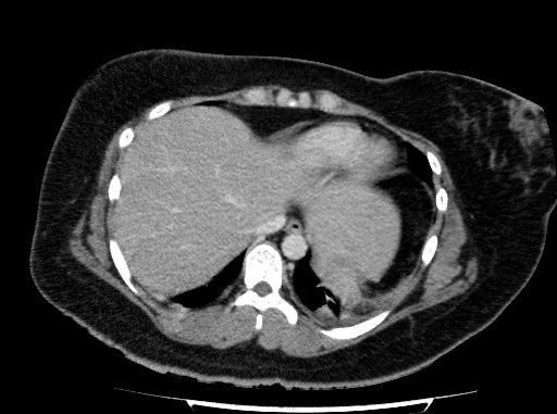 Acute pancreatitis (Radiopaedia 69236-79012 Axial C+ portal venous phase 12).jpg
