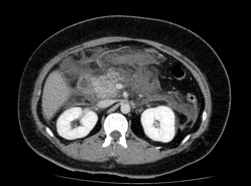Acute pancreatitis (Radiopaedia 69236-79012 Axial C+ portal venous phase 36).jpg