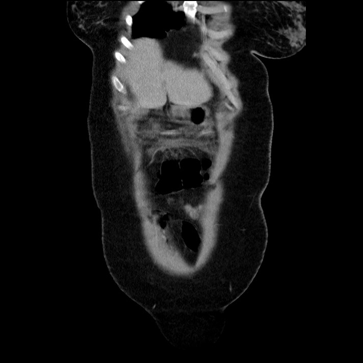 Acute pancreatitis (Radiopaedia 69236-79012 Coronal C+ portal venous phase 61).jpg